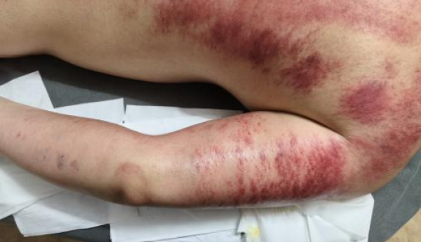 赵翌伊荣获拾遗传承“传统中医内病外治砭术诊疗法非物质文化遗产传承人”称号