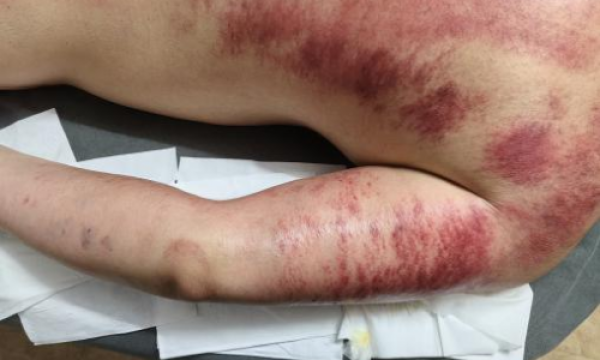 赵翌伊荣获拾遗传承“传统中医内病外治砭术诊疗法非物质文化遗产传承人”称号